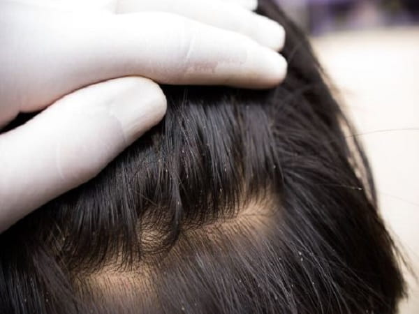 Nằm mộng thấy đầu có chấy nhưng không bắt được